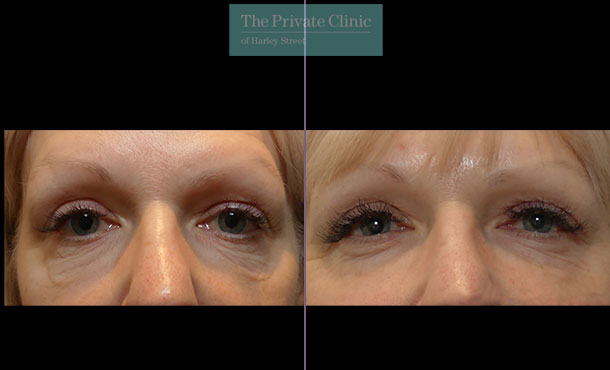 Laser Skin Tightening before and after - Thermage, Morpheus8, Ultherapy Skin  Tightening in London, Buckinghamshire