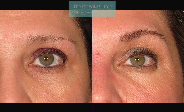 Ultherapy brow lift before after photo results