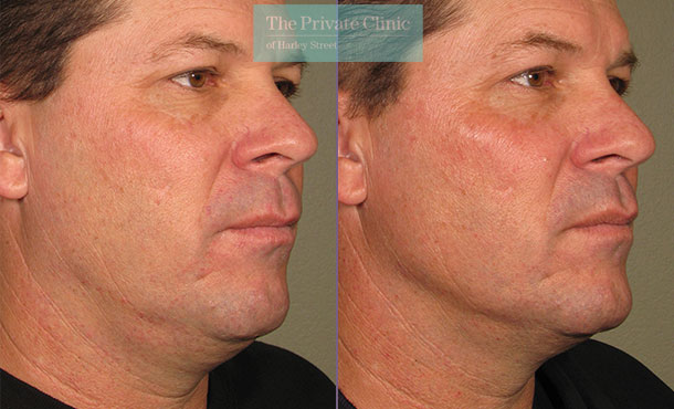 ultherapy necklift facelift non-surgical skin-tightening birmingham before after results