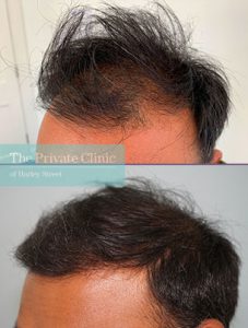 Hair Transplants for Receding Temples cost, hair transplant temples ...