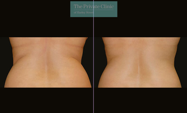 CoolSculpting - Before & After Images - The Private Clinic of Harley Street  London