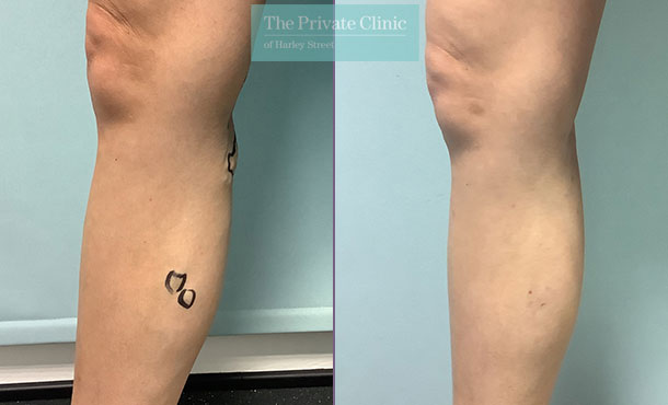 Varicose Vein - 003TH - Front