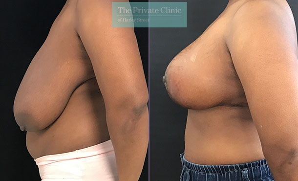 Breast Reduction Surgery Manchester