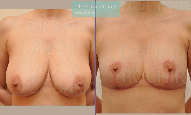 Breast Auto Augmentation - 008DR - Front