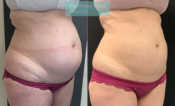 before and after results of coolsculpting