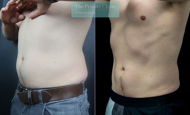 before and after results of coolsculpting