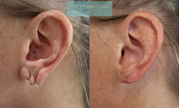 Split Earlobe Corrective Surgery By Ear Specialist Mark Sheldon Lloyd