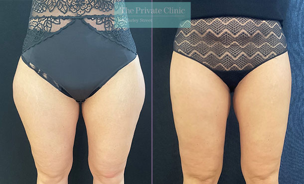 Women Thigh Shaper After Post Liposuction Fat Filling Double