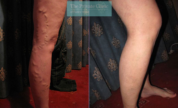 bulging varicose vein legs upper thigh before and after result photos