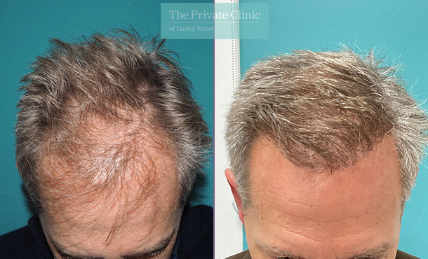 FUE Hair Transplant before and after results, frontal region restoration