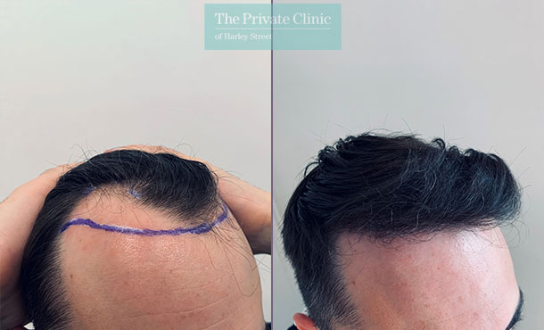 FUE Hair Transplant before and after results, temple and hairline restoration