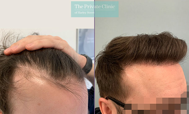 FUE Hair Transplant before and after result photos, temple hair restoration