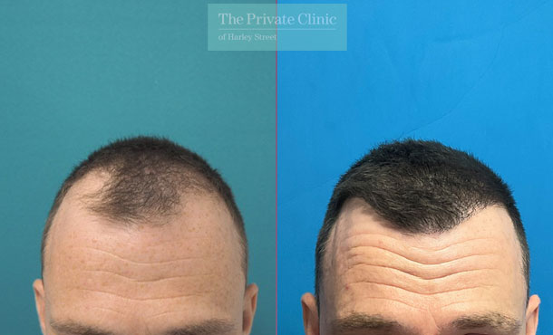 FUE Hair Transplant before and after result, temples