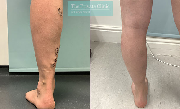 varicose vein removal before and after photos