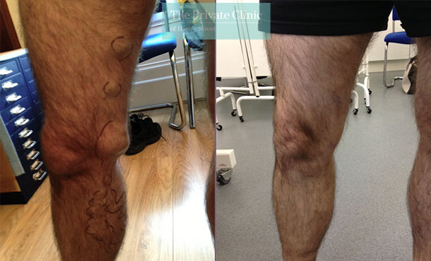 bulging veins upper thigh varicose vein removal before after photo