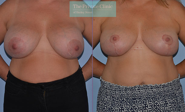 Breast reconstruction after breast implant removal, breast auto augmentation results