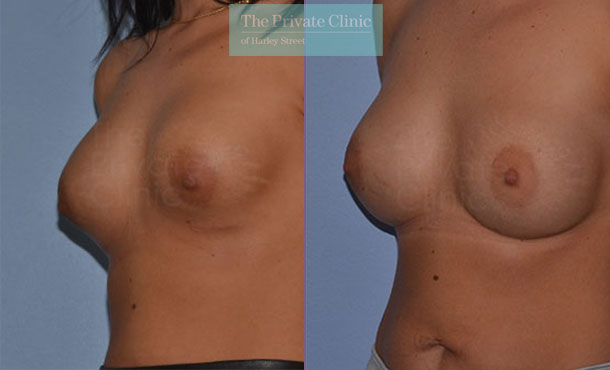 Removal and replacement of breast implants before and after results