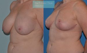 Breast Auto Augmentation before after photos