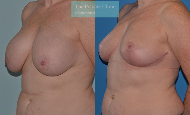 Breast auto augmentation before and after results