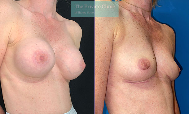 Breast implant removal before and after results