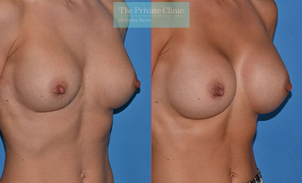 Breast implant replacement surgery before after results