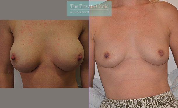 Breasts after breast implant removal