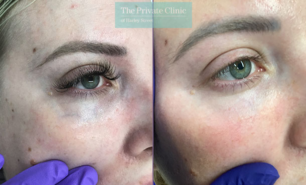 Veins Under Eyes The Private Clinic Of Harley Street London