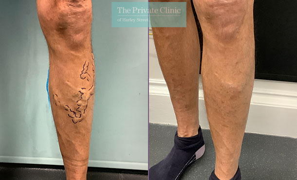 Varicose Veins - 003DP-Front