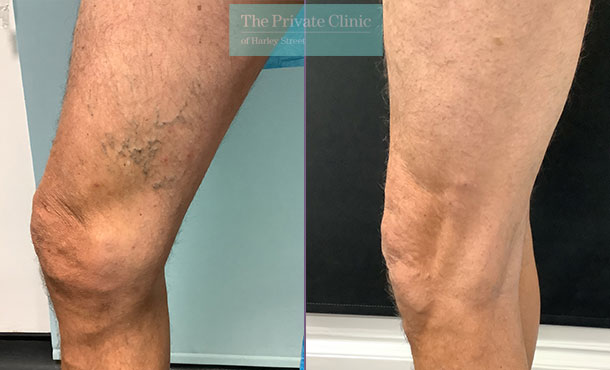 Varicose Veins - 003DP-Side