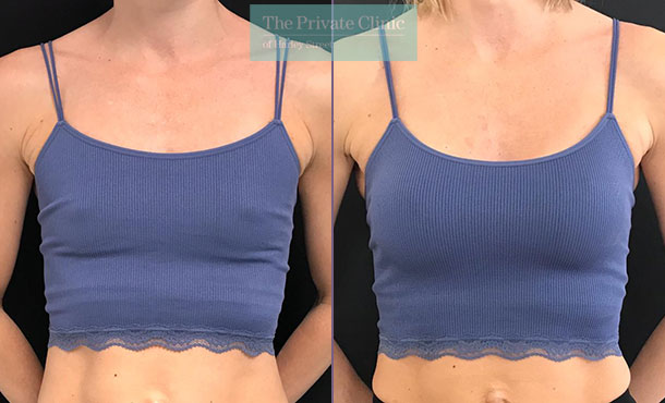 Mini Boob Job - Natural looking Breast Augmentation with smaller