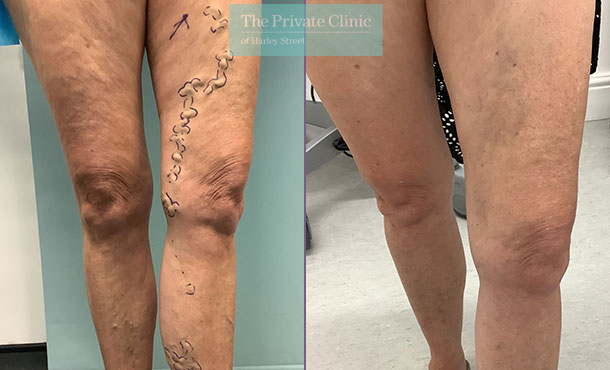 Varicose Vein Types - Liverpool Varicose Veins Clinic