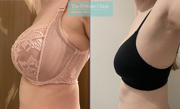 Breast Reduction: What The Surgery Experience Is Like