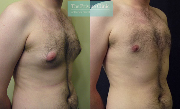 Puffy Nipples Men: What are Puffy Nipples? Causes and Treatments