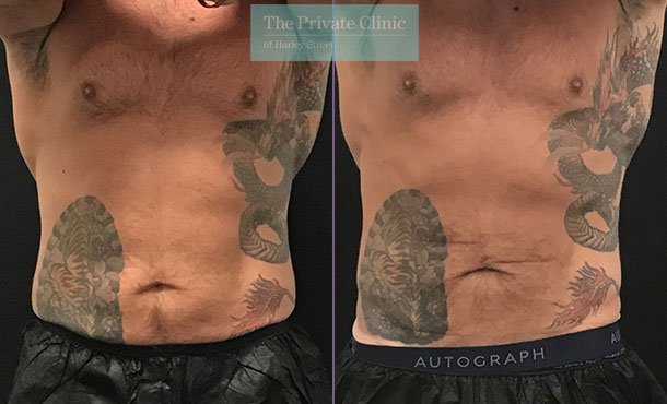 CoolSculpting Male Lower Abdomen Before After Pictures, Men Flanks Fat  removal