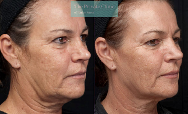 Thermage treatment face before and after results