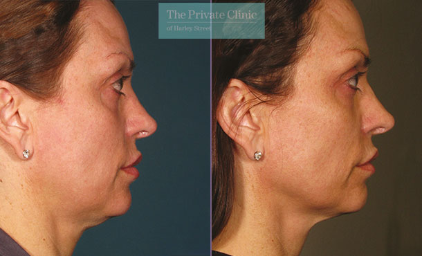 Ultherapy treatment face before and after photo results