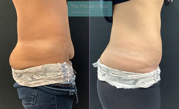 Overhang belly: Can I just get look to get rid of it or do I need a TT? :  r/PlasticSurgery