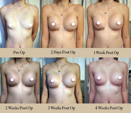 Breast Implants Before after photos from 2 days to 4 weeks