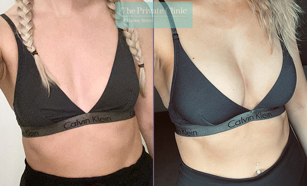 Result of a breast augmentation (cup size increase versus implant volume)