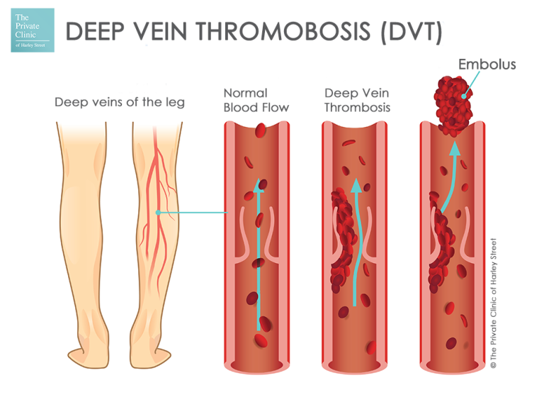 Deep vein thrombosis, DVT or venous thrombosis, blood clot in vein