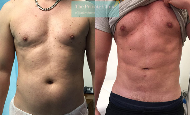 Exercise After Vaser Liposuction: Here's What You Need to Know - Harley  Clinic