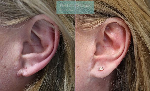 Split Earlobe - 041ML