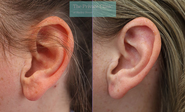 Split Earlobe - 044ML