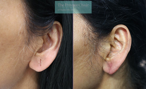 Split Earlobe - 048ML