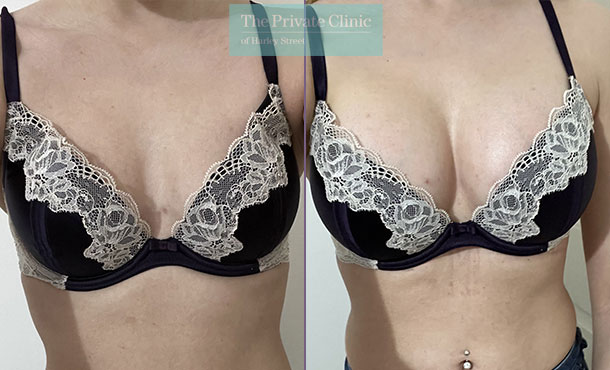 breast implants london before after result photo