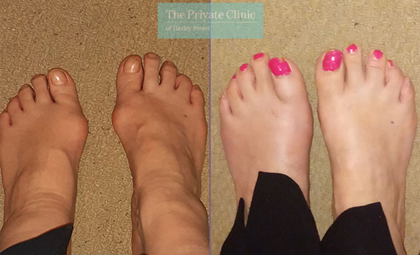 Bunion Surgery minimally invasive before and after photo