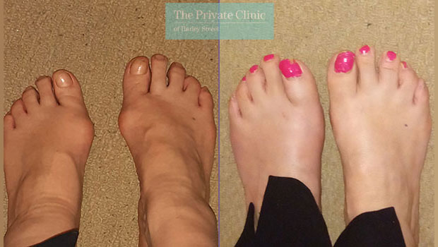 Bunion Surgery Teresa story- Minimally Invasive Technique reviews Testimonials