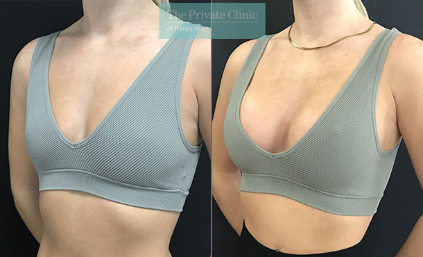 round breast implants natural result before after photo