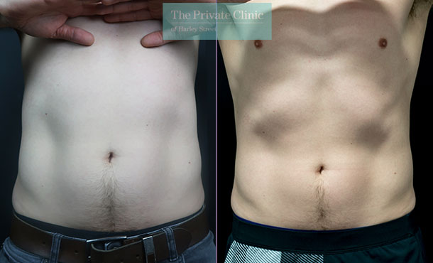 CoolSculpting men abdomen before and after photo result