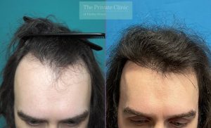 Forehead hair transplant before and after photos